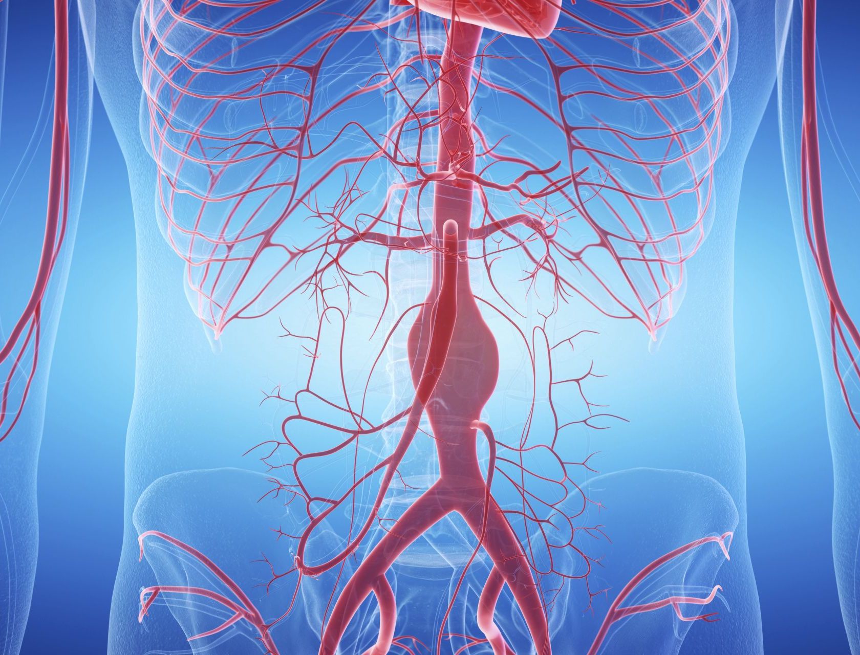 Illustration der Arterien im Körper mit Fokus auf eine aufgeblähte Arterie - Aneurysma