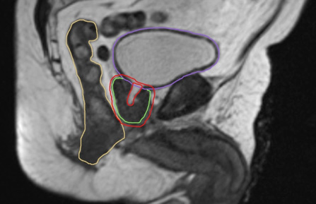 Stereotaktische Strahlentherapie MRI Aufnahme beim Pankreaskarzinom