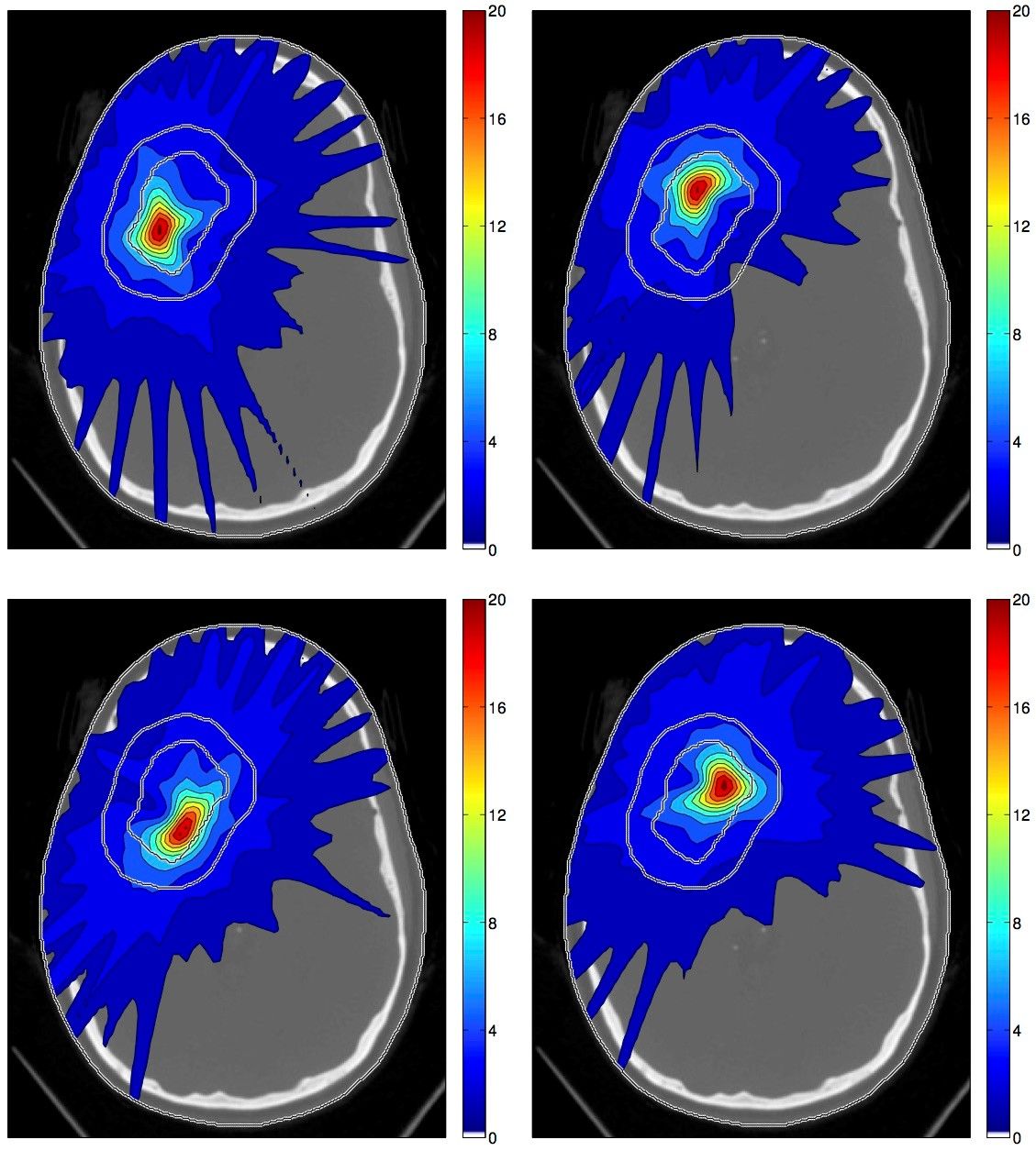 Spatiotemporal treatment plan for a large cerebral AVM