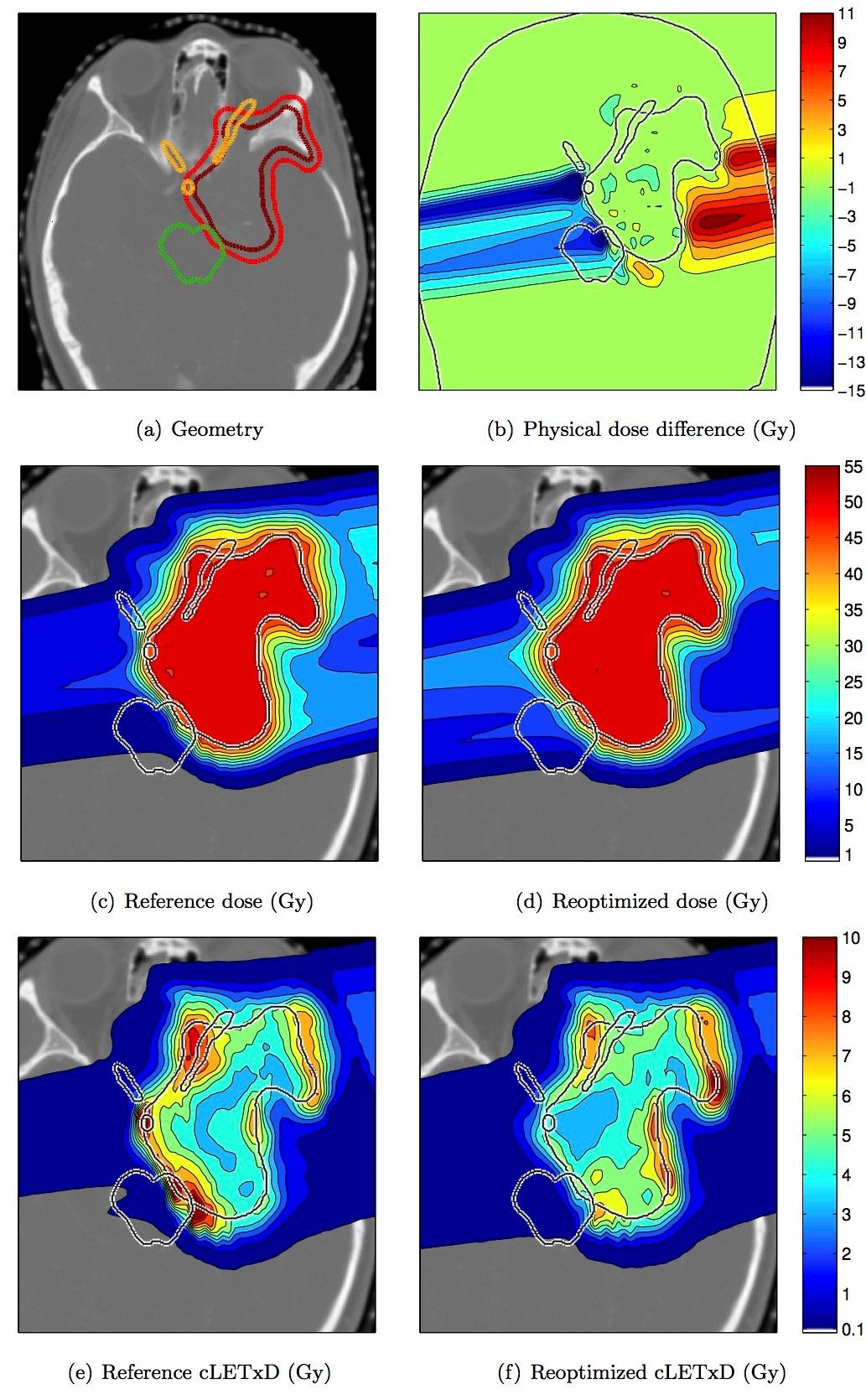 LET based IMPT reoptimization for a meningioma patient