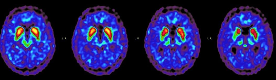 Figure: FDOPA PET of a patient with Parkinson’s disease, the tracer uptake in the right putamen is reduced.