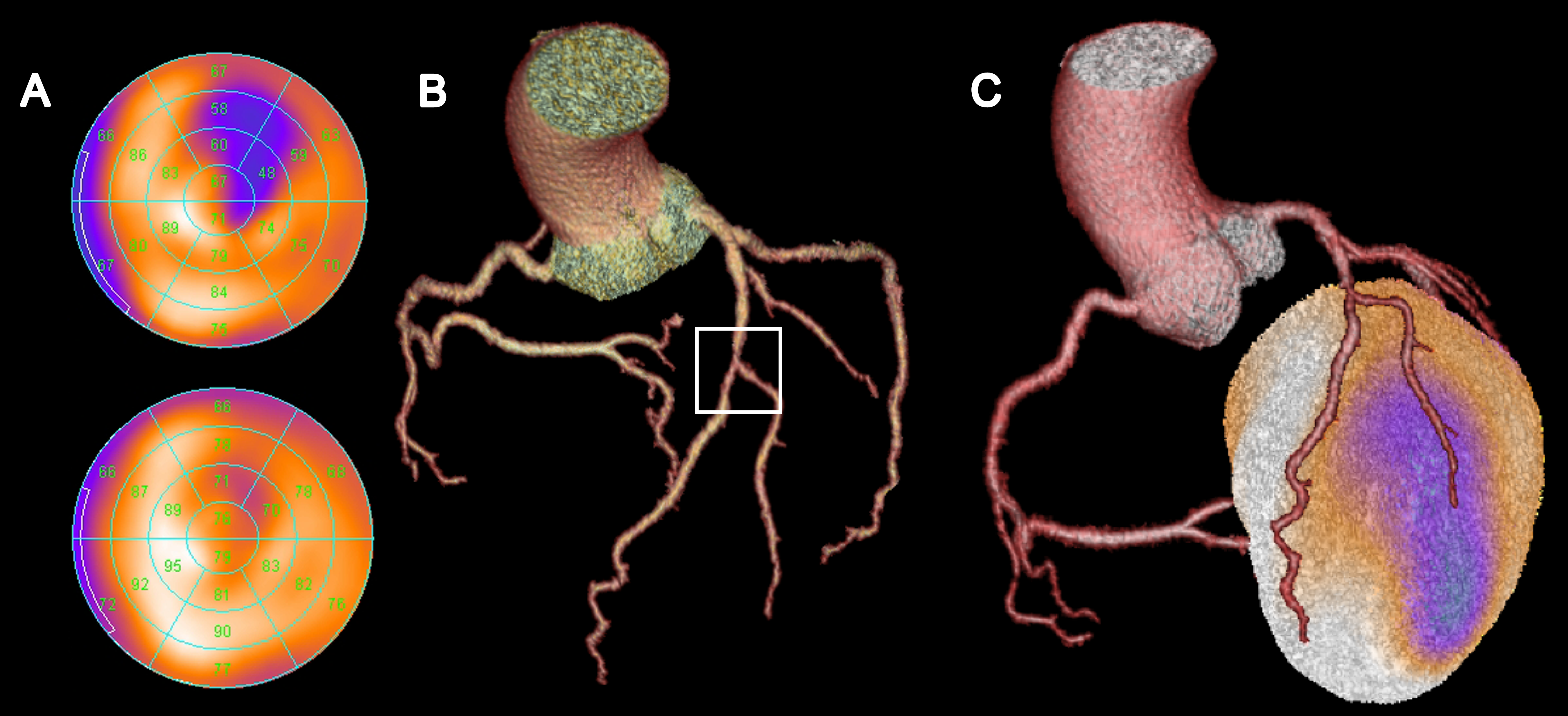 3D Aufnahme einer Aorta