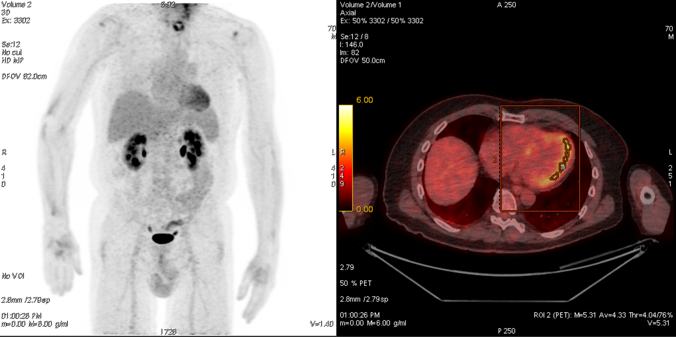 70-year-old patient with probable cardiac sarcoidosis, which could be clearly diagnosed by means of 18F-FDG PET / CT: The maximum intensity projection (left) shows clear metabolic activity in the left ventricular myocardium. The fused PET / CT (right) shows the increased activity (yellow) mainly in the lateral wall of the myocardium. In addition we can quantify the activity with PET (SUVmax here 5.31) which is particularly helpful for therapy monitoring.