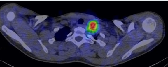 Figure 5: Thyroid carzinoma with retrojugular (lymph node) metastasis with radioiodine uptake.