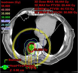 Dosisverteilung bei Stereotaktischer Radiotherapie eines wirbelsäulennahen Lungentumors.