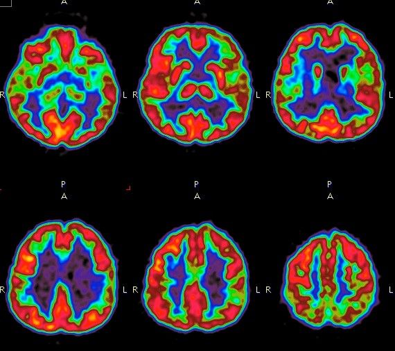 Verschiedene PET Aufnahmen eines Gehirns