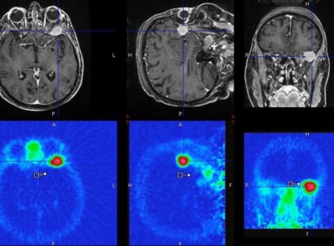 PET und MRI Aufnahmen eines Gehirns mit Meningeon