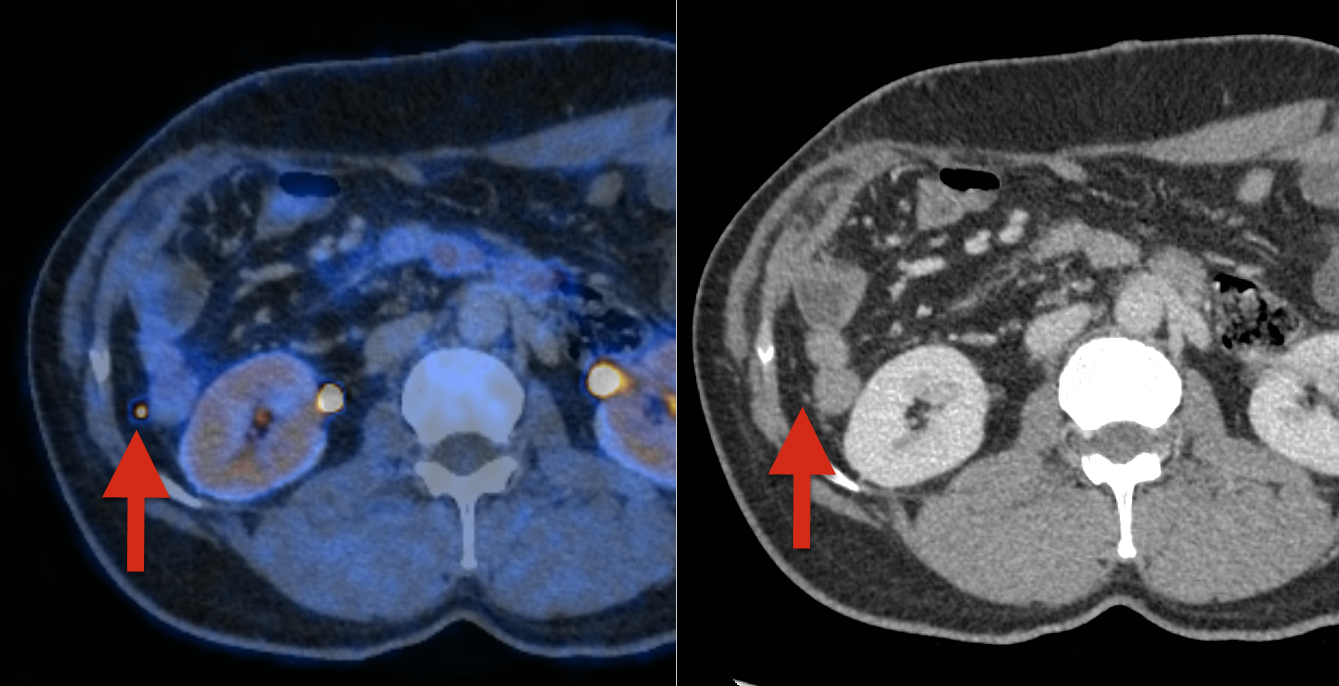 18F-DOPA-PET / CT detects a tiny metastasis (arrows) of a pheochromocytoma, which is practically not visible on the CT.