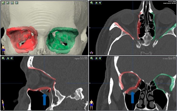 MRI Aufnahme eines Kiefers mit Trauma