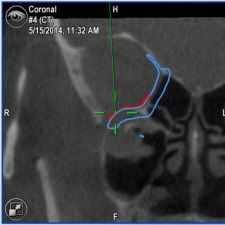 MRI Aufnahme eines Kiefers mit Trauma