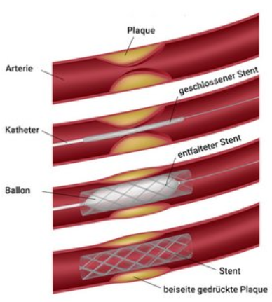 Illustration eines Katheter in einem Gefäss