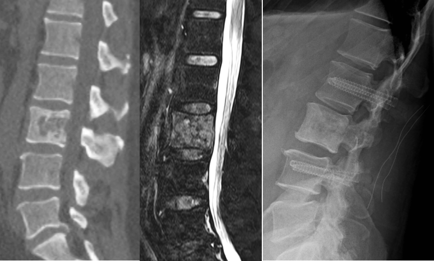 Computertomographie und Magnetresonanztomographie einer Krebs-Metastae