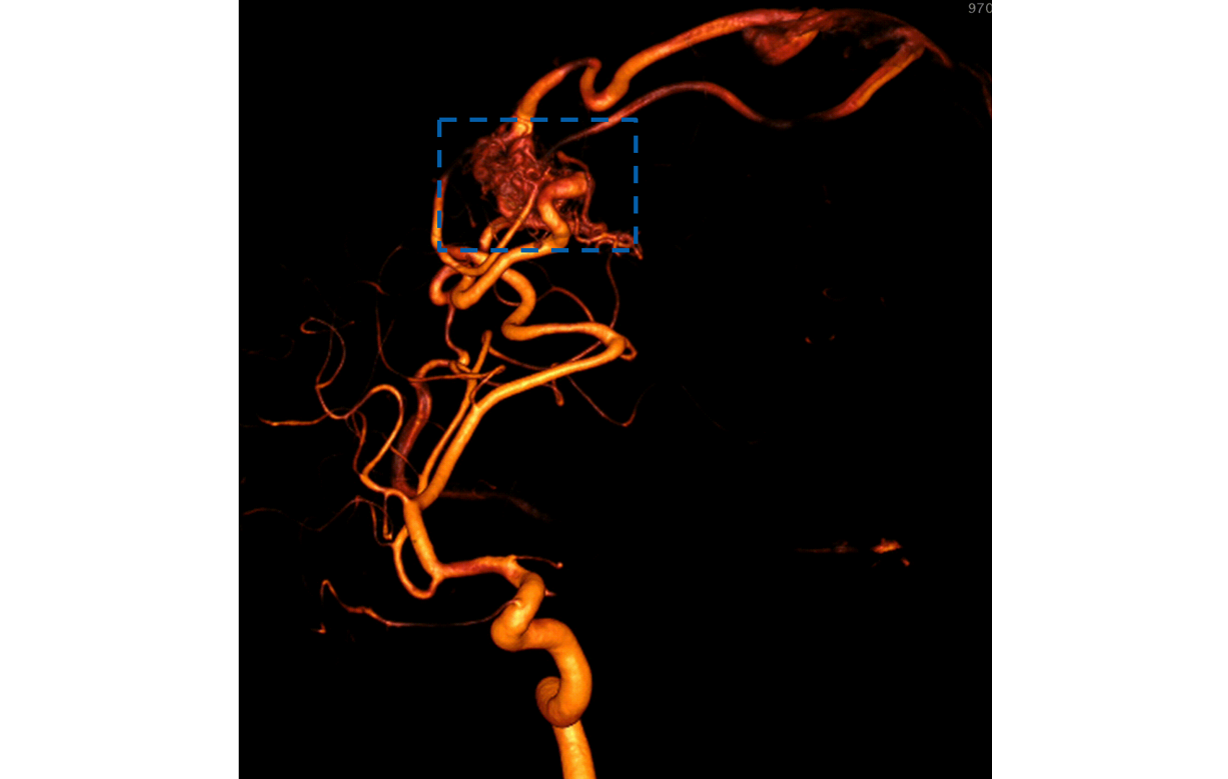 Gefässmissbildung (Arteriovenöse Malformation) in den Blutgefässen des Kopfes. Die AVM ist als Gefässknäuel sichtbar.