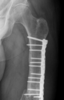 2.	Bruch einer Plattenosteosynthese am Oberschenkel