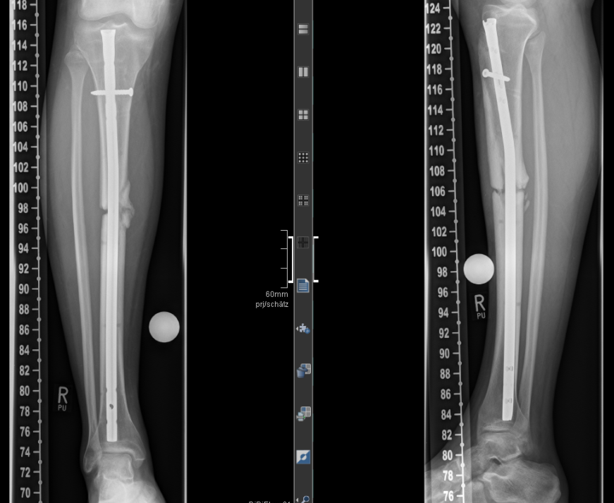 Die Röntgen Analyse einer Schienbein- Pseudarthrose nach Marknagelung 