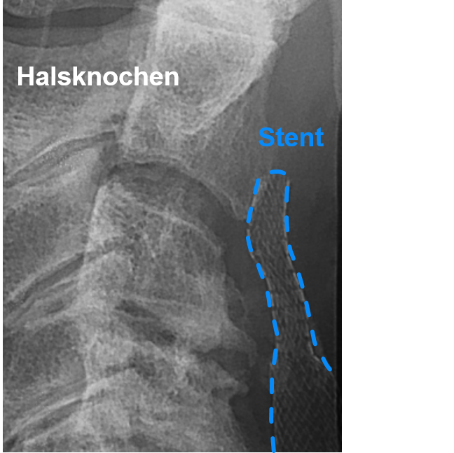 Röntgenaufnahme: Der Stent wurde im Gefäss am Hals platziert.