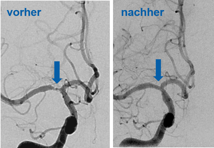 Die mittlere Gehirnschlagader vor und nach der Behandlung mit einem Stent. Vor der Behandlung ist das Blutgefäss verengt, danach ist die normale Breite wiederhergestellt.