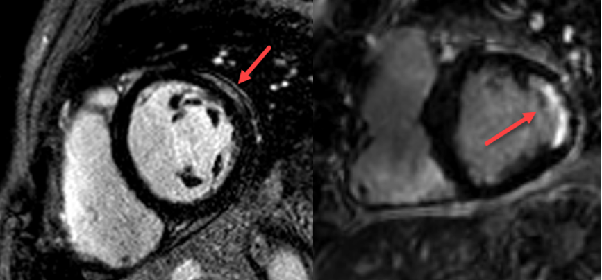 Herz-Magnetresonanztomographie (MRI)