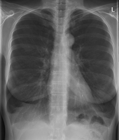 Röntgen-Übersichtsdarstellung des Brustkorbes bei COPD