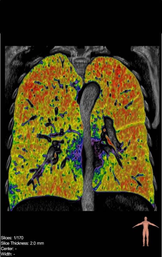 Computertomographie der Lunge bei COPD