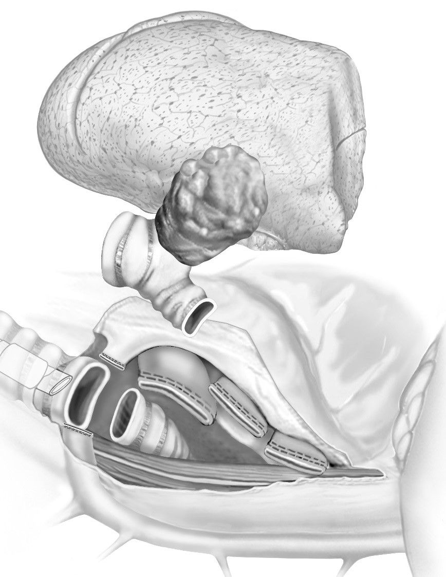 Illustration der Sleeve-Pneumonektomie