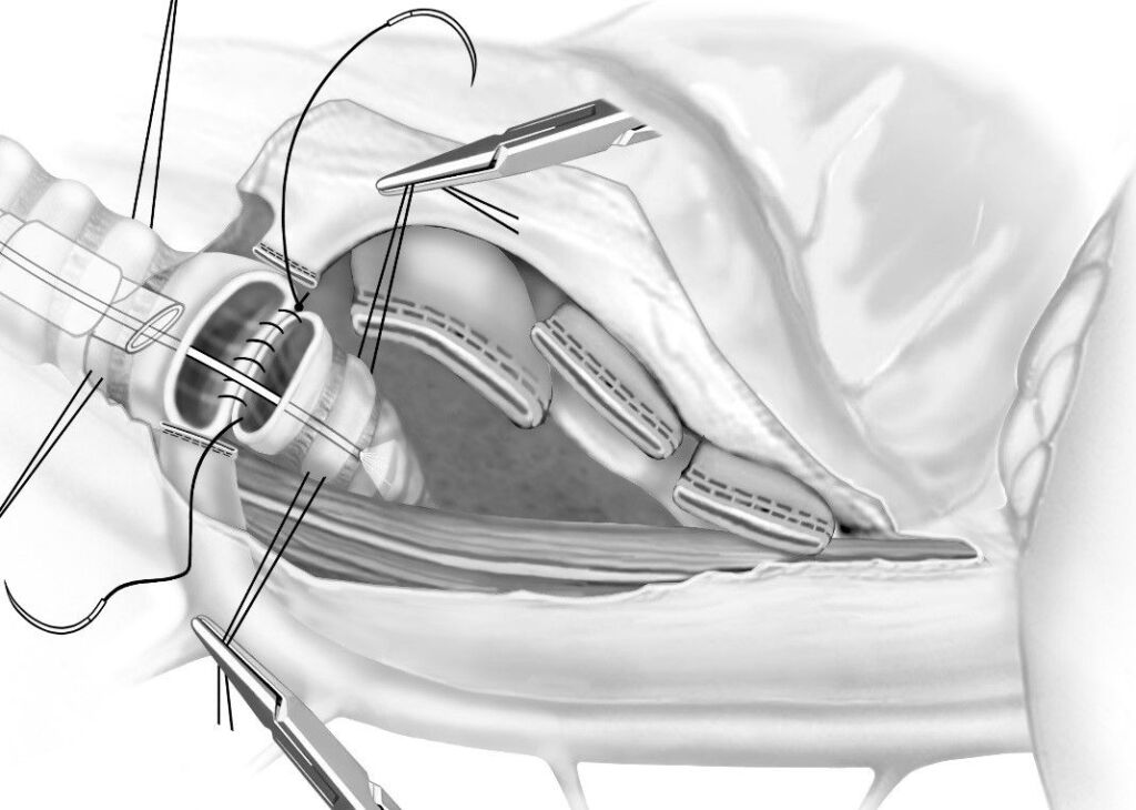 Illustration der Sleeve-Pneumonektomie