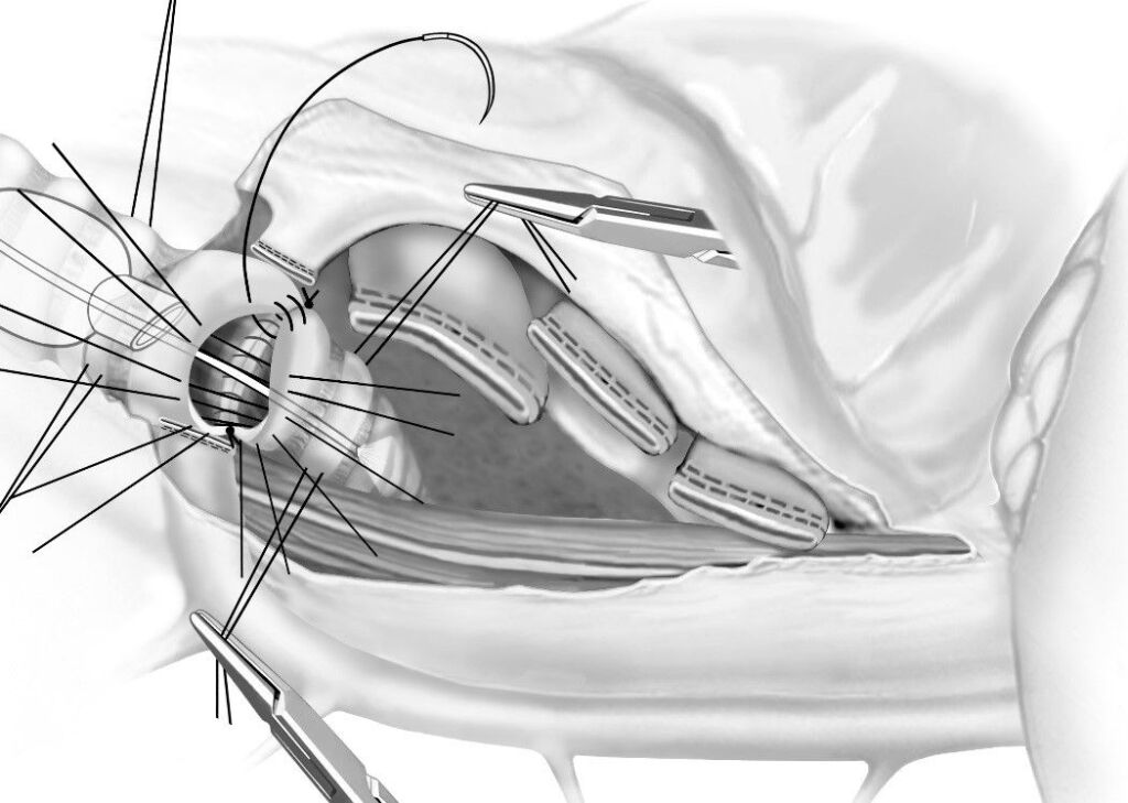 Illustration der Sleeve-Pneumonektomie