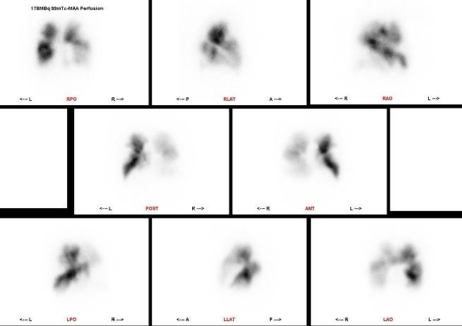 Figure: Lung scintigraphy in a patient with multiple lung emboli.