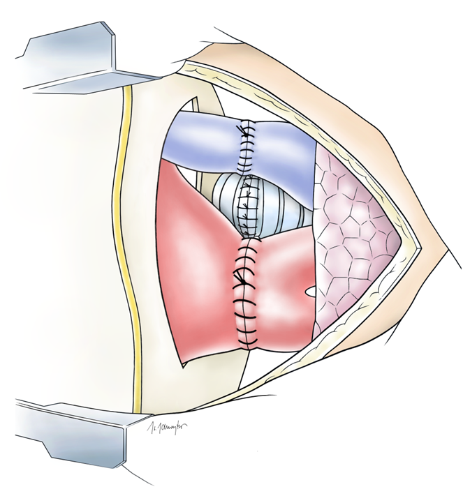 Illustration Implantation der Lunge