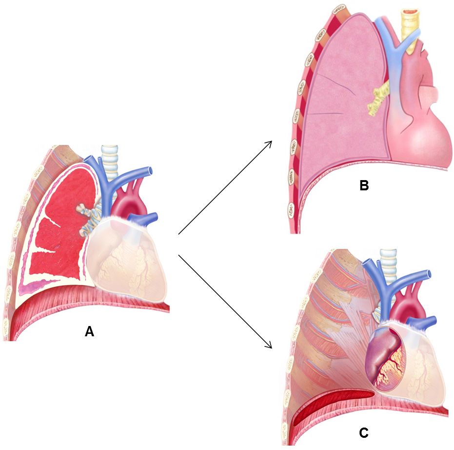 Illustration Operationsverfahren Extrapleurale Pneumonektomie 