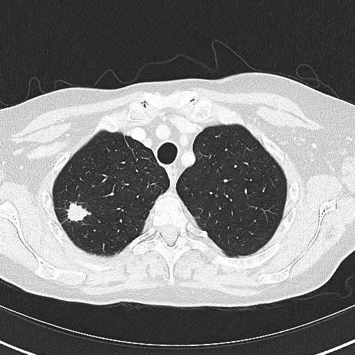 CT-Aufnahme solitäre Lungeherde Bronchuskarzinom