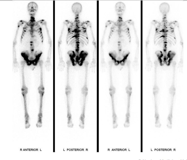 Figure: Bone scintigraphy in a patient with prostate cancer.