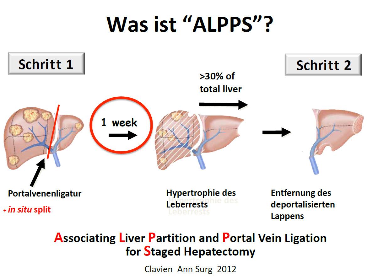 Skizzierung ALPPS