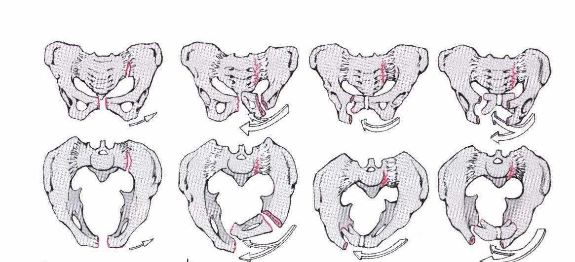 Illustration Rotatorisch instabile Brüche 