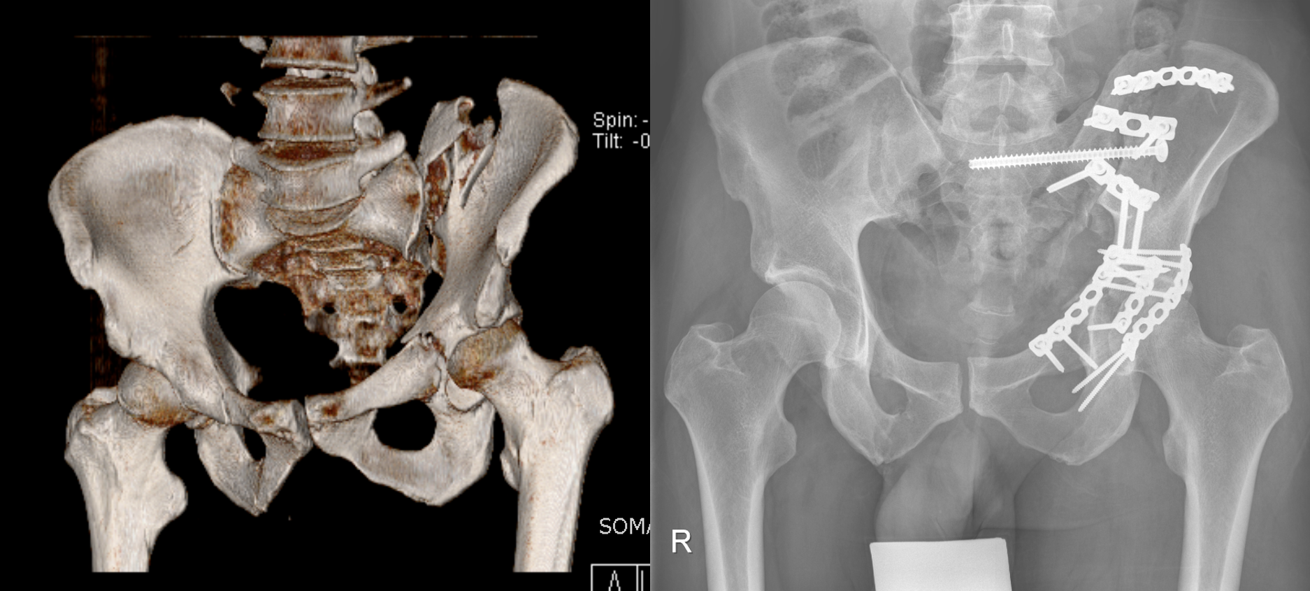 Links: 3D-Darstellung einer Computertomographie nach kombiniertem linksseitigem Becken- und Hüftpfannenbrauch. Rechts:Postoperatives Röntgen nach Fixation mit Platten und Schrauben.