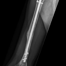 Röntgenbild Pseudoarthrose geheilt