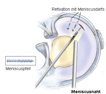 Illustration von der Kniegelenks-Spiegelung (Arthroskopie)