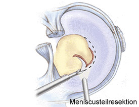 Illustration von der Kniegelenks-Spiegelung (Arthroskopie)