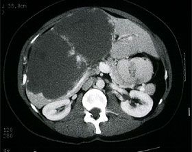 Computertomogramm eines Riesenhämangioms der Leber