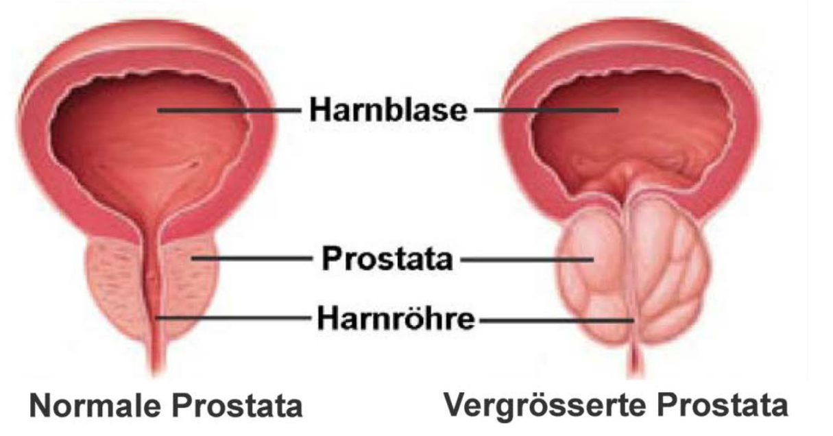 Prostata Illustration