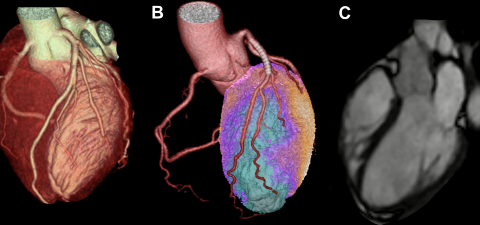 Kardiale Bildgebung mittels CT (A), Hybrid-Untersuchung (hier Kombination aus CT und PET) (B) und Herz-MRI (C) bei verschiedenen Patienten und Patientinnen.