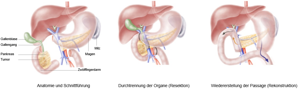 Schematische Darstellung der Operation nach Kausch Whipple