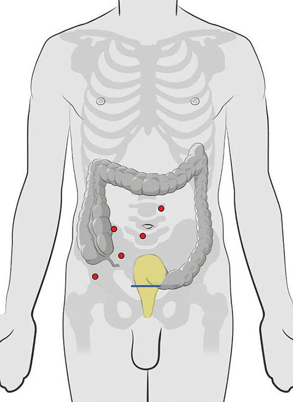 Platzierung der Instrumente bei einer Enddarmkrebsoperation