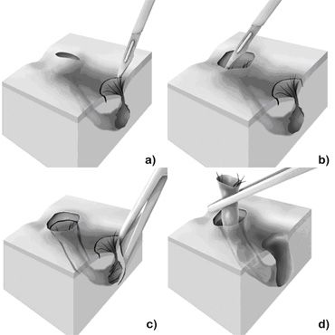 Sparsames Ausschneiden der Steissbeinfistel