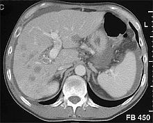 Computertomographie der Leber drei Monate nach intraarterieller Chemotherapie und Ligatur der rechten Pfortader bei einem Patienten mit hepatozellulärem Karzinom.