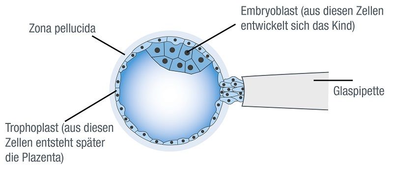 Entnahme von mehreren Zellen aus dem Trophoblasten für die Präimplantationsdiagnostik.