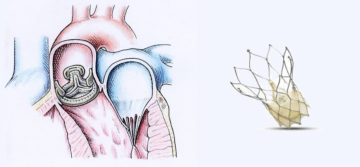 Ersatz der Aortenklappe mit einer biologischen Prothese (links). Katheter-technische Klappe (rechts) innerhalb einem metall-armierten Stent zur Selbstverankerung