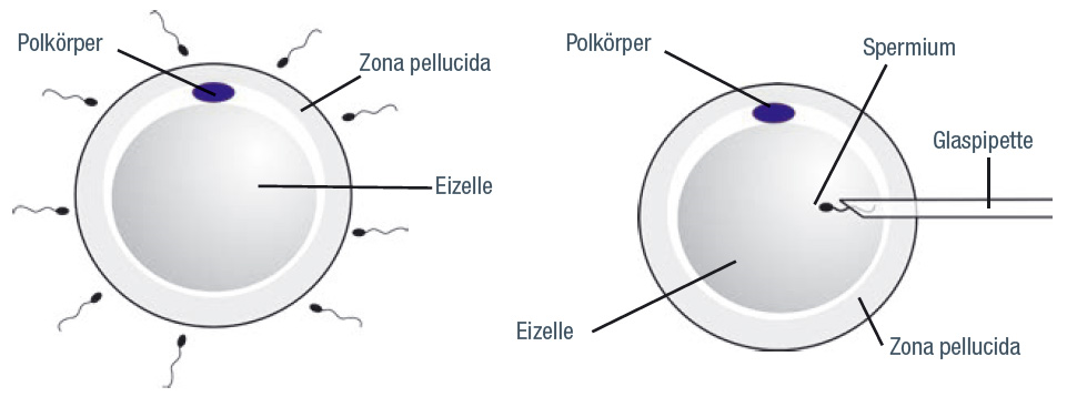 Insemination bei der IVF links und Insemination bei der ICSI rechts