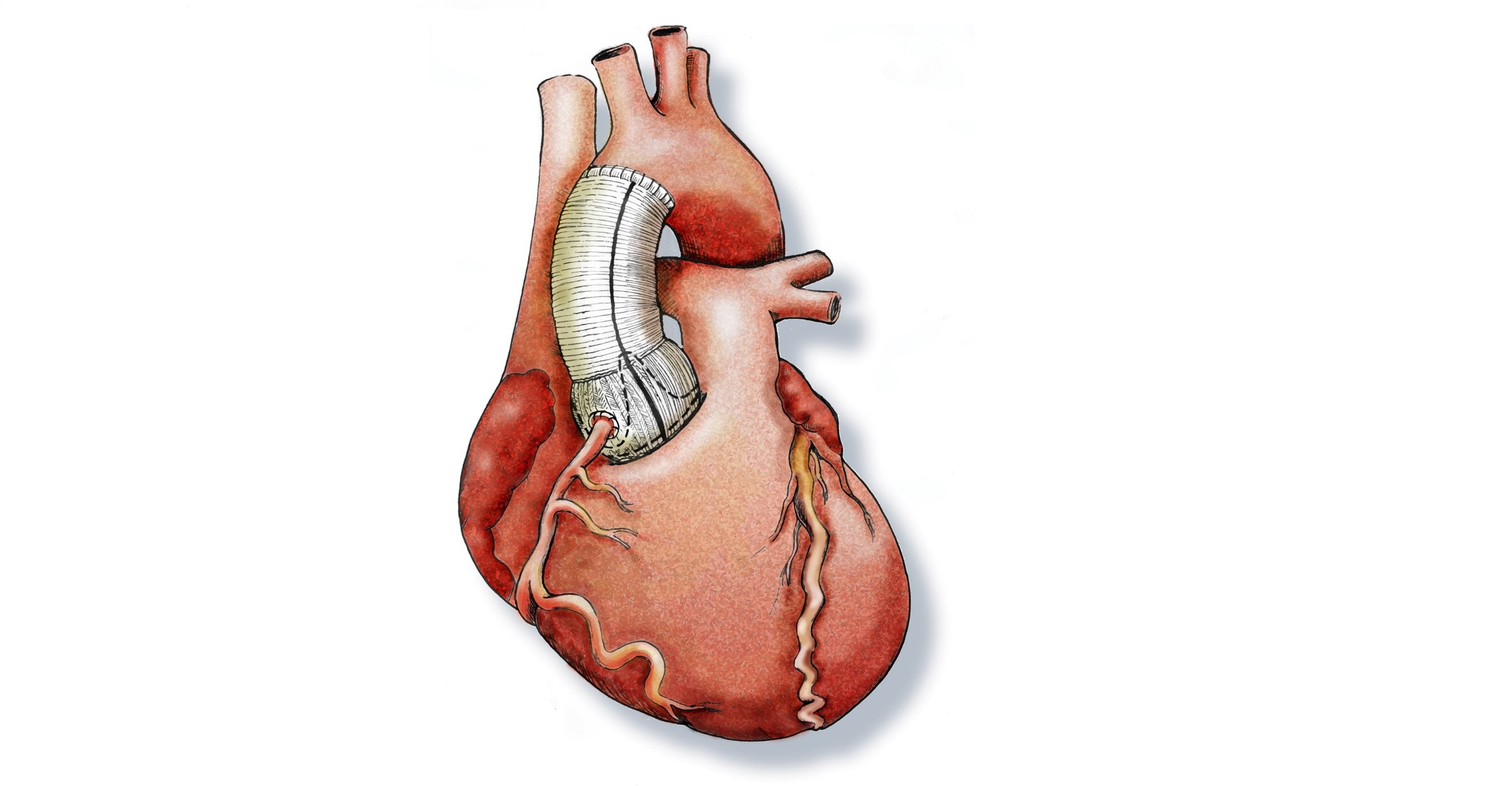 Ersatz der Aorta ascendens mit einer Klappen- und Gefässprothese mit Re-implantation der Koronargefässen