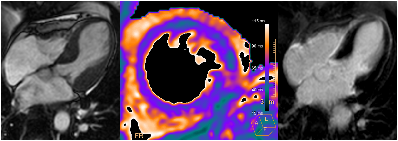 Herz-MRI